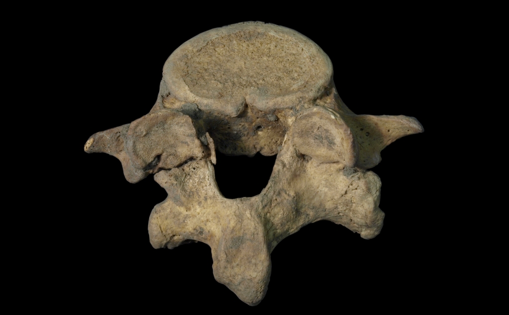 Zdjęcie badanego kręgu ludzkiego ze złamaniem